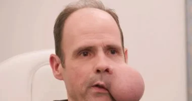 رجل يعيش بوجه يزن 2 كيلوجرامًا!.. اعرف القصة المؤلمة